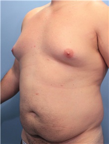 Liposuction Before Photo by Marvin Shienbaum, MD; Brandon, FL - Case 46635