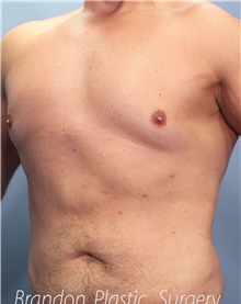 Liposuction After Photo by Marvin Shienbaum, MD; Brandon, FL - Case 46635