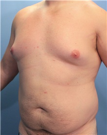 Liposuction Before Photo by Marvin Shienbaum, MD; Brandon, FL - Case 46635