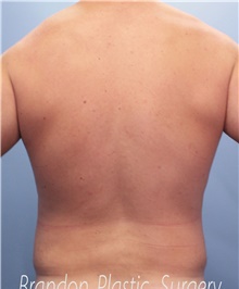 Liposuction After Photo by Marvin Shienbaum, MD; Brandon, FL - Case 46635