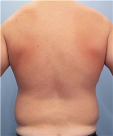 Liposuction Before Photo by Marvin Shienbaum, MD; Brandon, FL - Case 46635