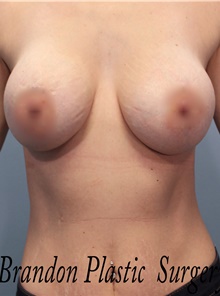 Breast Augmentation After Photo by Marvin Shienbaum, MD; Brandon, FL - Case 46795