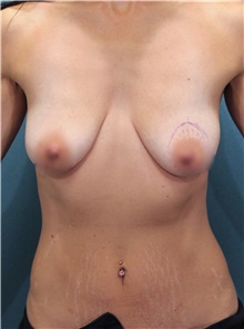 Breast Augmentation Before Photo by Marvin Shienbaum, MD; Brandon, FL - Case 46795