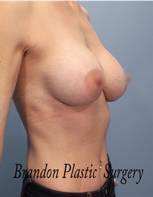 Breast Augmentation After Photo by Marvin Shienbaum, MD; Brandon, FL - Case 46795