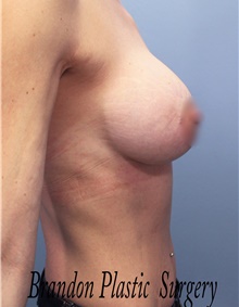 Breast Augmentation After Photo by Marvin Shienbaum, MD; Brandon, FL - Case 46795