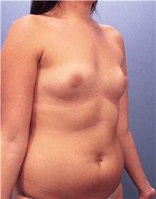 Breast Augmentation Before Photo by Marvin Shienbaum, MD; Brandon, FL - Case 46803