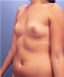 Breast Augmentation Before Photo by Marvin Shienbaum, MD; Brandon, FL - Case 46803