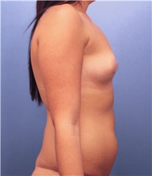 Breast Augmentation Before Photo by Marvin Shienbaum, MD; Brandon, FL - Case 46803