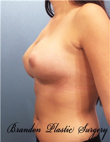 Breast Augmentation After Photo by Marvin Shienbaum, MD; Brandon, FL - Case 46803