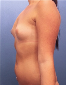 Breast Augmentation Before Photo by Marvin Shienbaum, MD; Brandon, FL - Case 46803