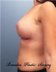 Breast Augmentation After Photo by Marvin Shienbaum, MD; Brandon, FL - Case 46803