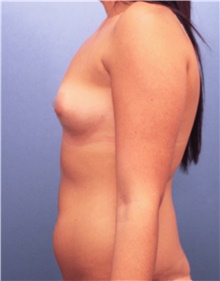 Breast Augmentation Before Photo by Marvin Shienbaum, MD; Brandon, FL - Case 46803