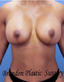 Breast Lift After Photo by Marvin Shienbaum, MD; Brandon, FL - Case 46930