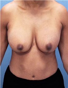 Breast Lift Before Photo by Marvin Shienbaum, MD; Brandon, FL - Case 46930