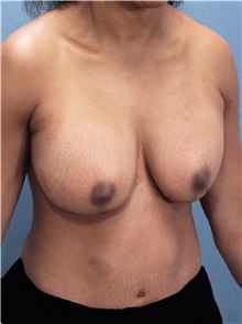 Breast Lift Before Photo by Marvin Shienbaum, MD; Brandon, FL - Case 46930