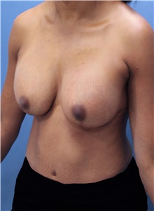 Breast Lift Before Photo by Marvin Shienbaum, MD; Brandon, FL - Case 46930