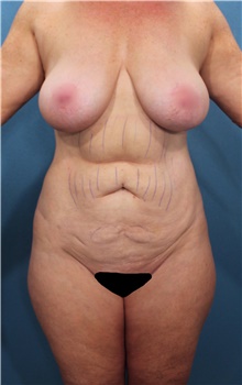 Liposuction Before Photo by Marvin Shienbaum, MD; Brandon, FL - Case 47252