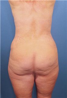 Liposuction Before Photo by Marvin Shienbaum, MD; Brandon, FL - Case 47252