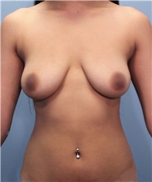 Breast Augmentation Before Photo by Marvin Shienbaum, MD; Brandon, FL - Case 47253