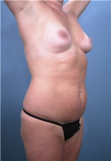 Liposuction Before Photo by Marvin Shienbaum, MD; Brandon, FL - Case 47259