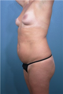 Liposuction Before Photo by Marvin Shienbaum, MD; Brandon, FL - Case 47259