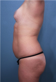 Liposuction Before Photo by Marvin Shienbaum, MD; Brandon, FL - Case 47259