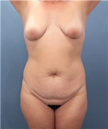 Tummy Tuck Before Photo by Marvin Shienbaum, MD; Brandon, FL - Case 47261