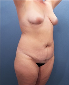 Tummy Tuck Before Photo by Marvin Shienbaum, MD; Brandon, FL - Case 47261