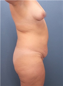 Tummy Tuck Before Photo by Marvin Shienbaum, MD; Brandon, FL - Case 47261