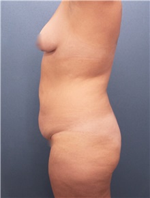 Tummy Tuck Before Photo by Marvin Shienbaum, MD; Brandon, FL - Case 47261