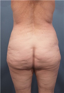 Buttock Lift with Augmentation Before Photo by Marvin Shienbaum, MD; Brandon, FL - Case 47267