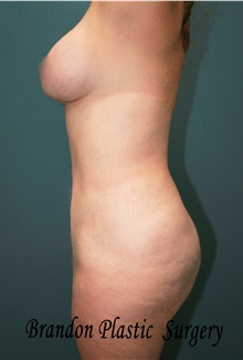 Buttock Lift with Augmentation After Photo by Marvin Shienbaum, MD; Brandon, FL - Case 47267