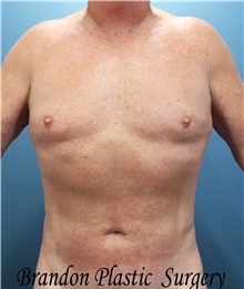 Liposuction After Photo by Marvin Shienbaum, MD; Brandon, FL - Case 47442