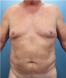 Liposuction Before Photo by Marvin Shienbaum, MD; Brandon, FL - Case 47442