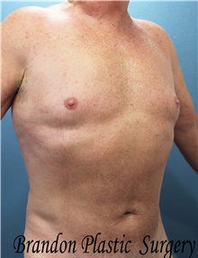 Liposuction After Photo by Marvin Shienbaum, MD; Brandon, FL - Case 47442