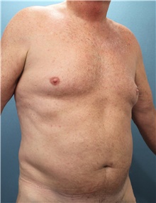 Liposuction Before Photo by Marvin Shienbaum, MD; Brandon, FL - Case 47442