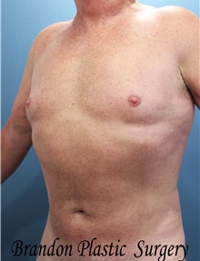 Liposuction After Photo by Marvin Shienbaum, MD; Brandon, FL - Case 47442