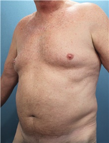 Liposuction Before Photo by Marvin Shienbaum, MD; Brandon, FL - Case 47442