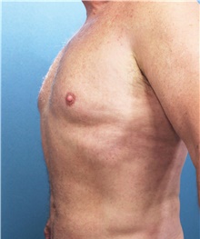 Liposuction After Photo by Marvin Shienbaum, MD; Brandon, FL - Case 47442