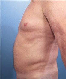 Liposuction Before Photo by Marvin Shienbaum, MD; Brandon, FL - Case 47442