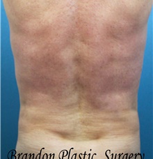 Liposuction After Photo by Marvin Shienbaum, MD; Brandon, FL - Case 47442