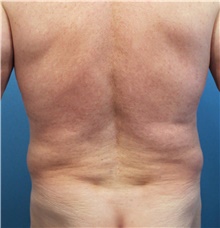 Liposuction Before Photo by Marvin Shienbaum, MD; Brandon, FL - Case 47442