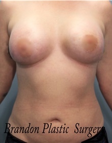 Breast Augmentation After Photo by Marvin Shienbaum, MD; Brandon, FL - Case 47443