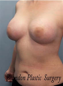 Breast Augmentation After Photo by Marvin Shienbaum, MD; Brandon, FL - Case 47443