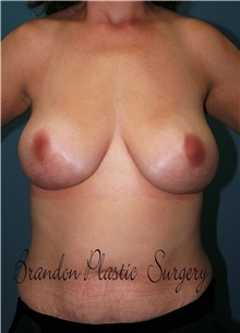 Breast Lift After Photo by Marvin Shienbaum, MD; Brandon, FL - Case 47444