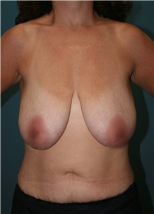 Breast Lift Before Photo by Marvin Shienbaum, MD; Brandon, FL - Case 47444