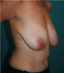 Breast Lift Before Photo by Marvin Shienbaum, MD; Brandon, FL - Case 47444