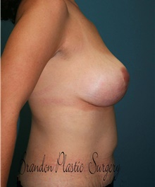 Breast Lift After Photo by Marvin Shienbaum, MD; Brandon, FL - Case 47444