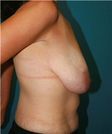 Breast Lift Before Photo by Marvin Shienbaum, MD; Brandon, FL - Case 47444