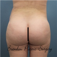 Buttock Lift with Augmentation After Photo by Marvin Shienbaum, MD; Brandon, FL - Case 48600